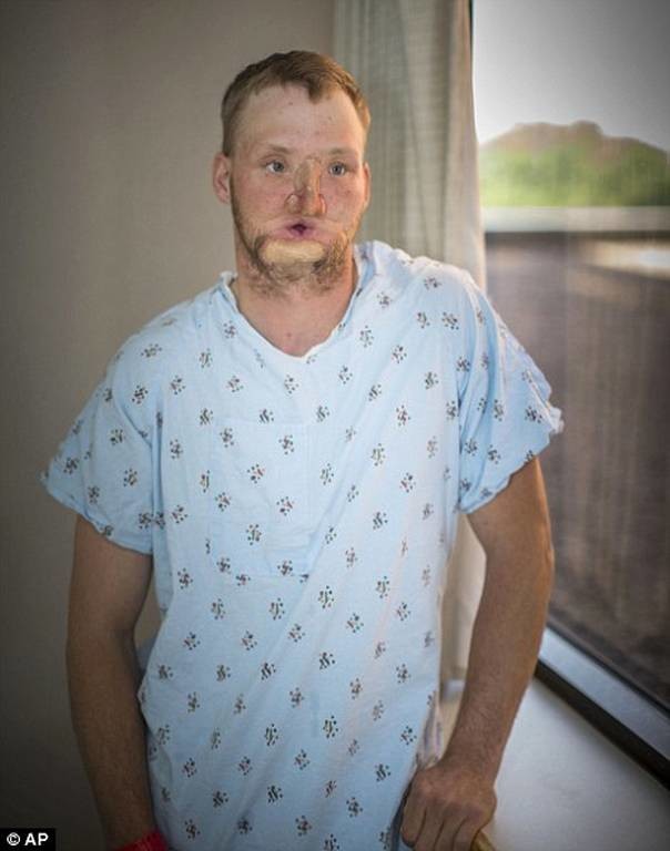 Μινεσότα: Η συγκλονιστική ιστορία νεαρού άνδρα που υποβλήθηκε σε μεταμόσχευση προσώπου (pics+vid)