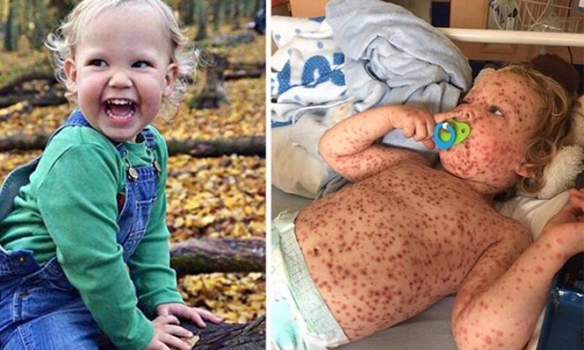 Ντροπή! «Ανέβασαν» στο Facebook φωτογραφία παιδιού με ανεμοβλογιά και έλεγαν ότι έχει καρκίνο