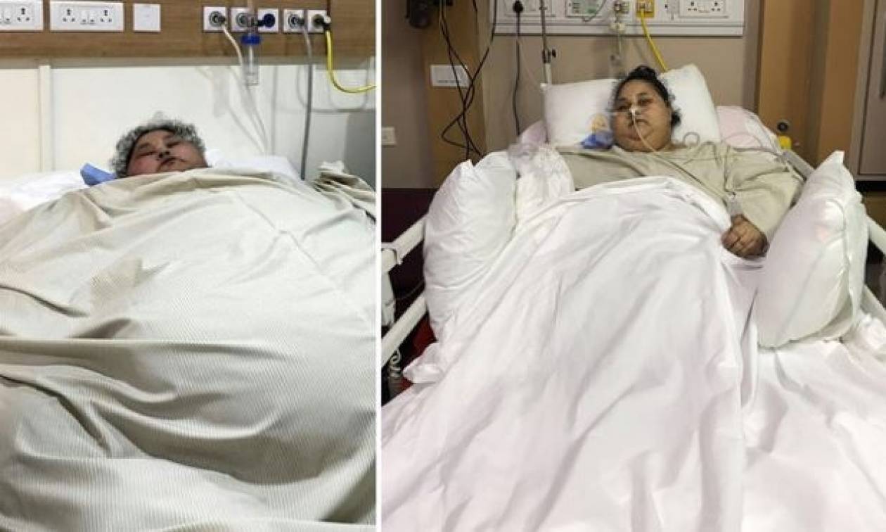 Ινδία: Η πιο παχύσαρκη γυναίκα στον κόσμο έχασε 100 κιλά με χειρουργική επέμβαση