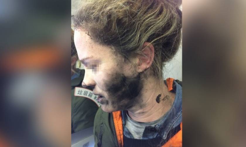 Τρομακτικτό ατύχημα: Εξερράγησαν τα ακουστικά στο πρόσωπό της εν μέσω πτήσης (pics)