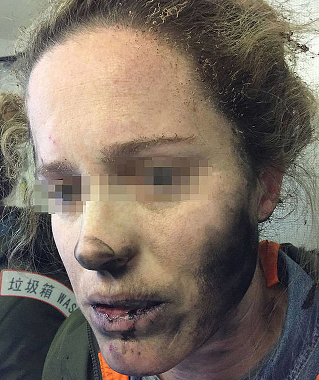 Τρομακτικτό ατύχημα: Εξερράγησαν τα ακουστικά στο πρόσωπό της εν μέσω πτήσης (pics)