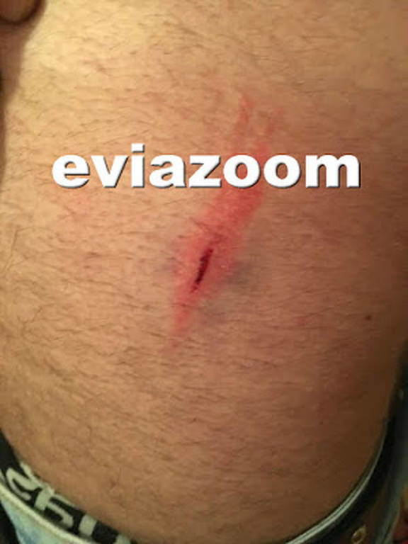 Απίστευτο περιστατικό στη Χαλκίδα: Του επιτέθηκε με σκαλιστήρι μετά από έντονη λογομαχία! (pics)
