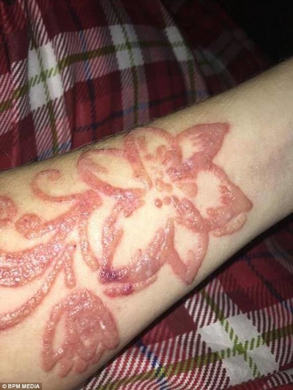 Σοκ: Δείτε τι έπαθε τουρίστρια που έκανε τατουάζ χένας (ΠΡΟΣΟΧΗ ΣΚΛΗΡΕΣ ΕΙΚΟΝΕΣ) 