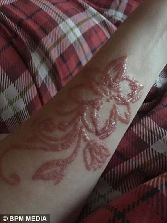 Σοκ: Δείτε τι έπαθε τουρίστρια που έκανε τατουάζ χένας (ΠΡΟΣΟΧΗ ΣΚΛΗΡΕΣ ΕΙΚΟΝΕΣ) 