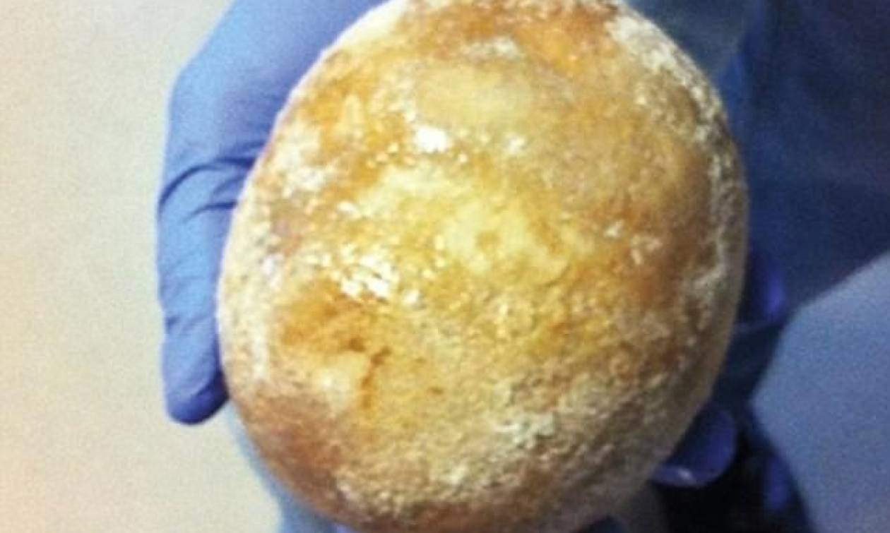 Σοκαρισμένοι οι γιατροί αφαίρεσαν πέτρα μεγέθους όσο ένα αυγό στρουθοκαμήλου από ουροδόχο κύστη