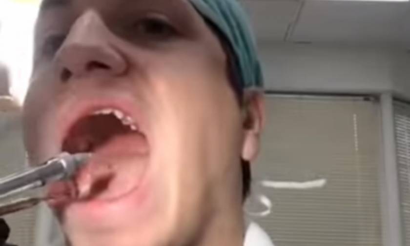 Οδοντίατρος βγάζει μόνος του τον φρονιμίτη του (vid)