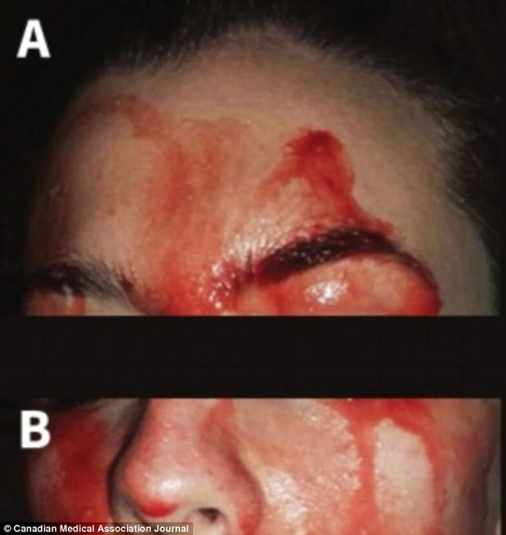 Ανατριχίλα! Γυναίκα γεμίζει με αίματα στο πρόσωπο όταν ιδρώνει - ΠΡΟΣΟΧΗ: ΣΚΛΗΡΕΣ ΕΙΚΟΝΕΣ