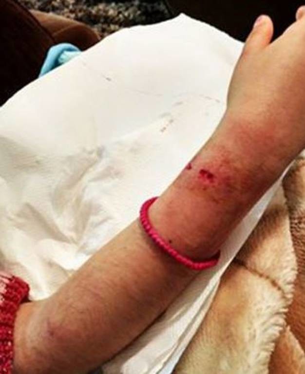 Μυτιλήνη - Σκύλος επιτέθηκε σε 7χρονη στο Χριστουγεννιάτικο Χωριό: Εικόνες - σοκ