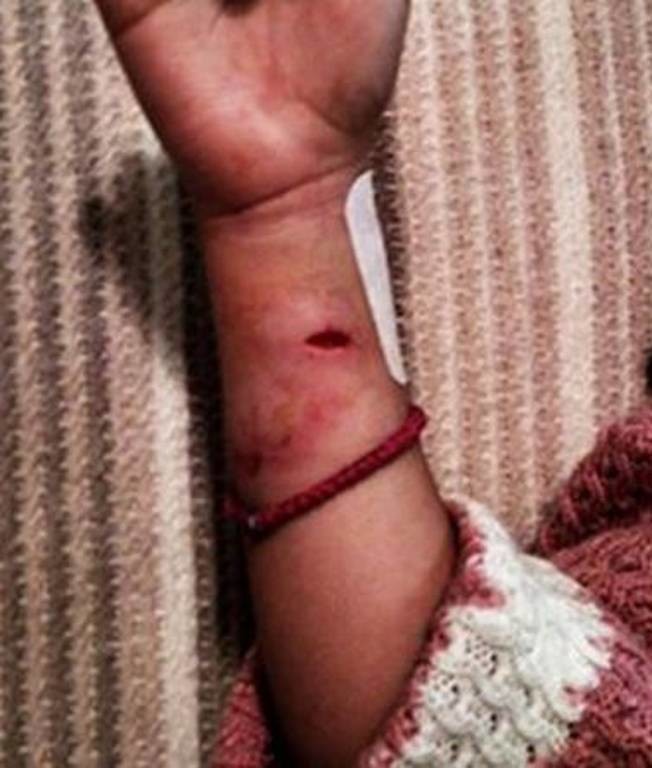 Μυτιλήνη - Σκύλος επιτέθηκε σε 7χρονη στο Χριστουγεννιάτικο Χωριό: Εικόνες - σοκ