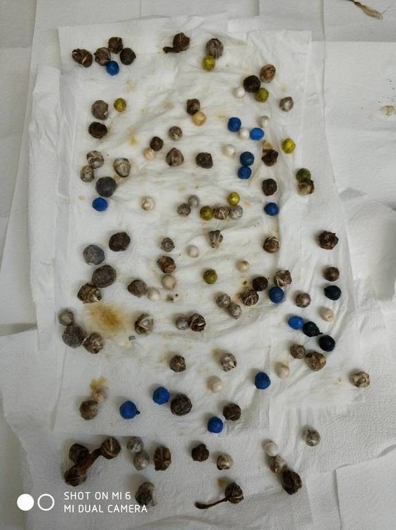 ΣΟΚ στην Πάτρα: Ασθενής «γέννησε» 120 αυγά – Απίστευτες εικόνες