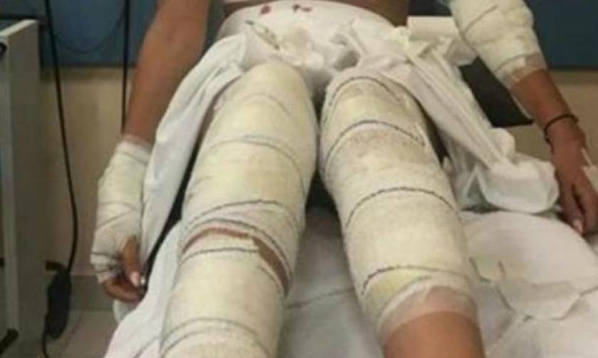 Κάτω Αχαΐα: Σκύλος δάγκωσε 25χρονη - Μεταφέρθηκε στο νοσοκομείο
