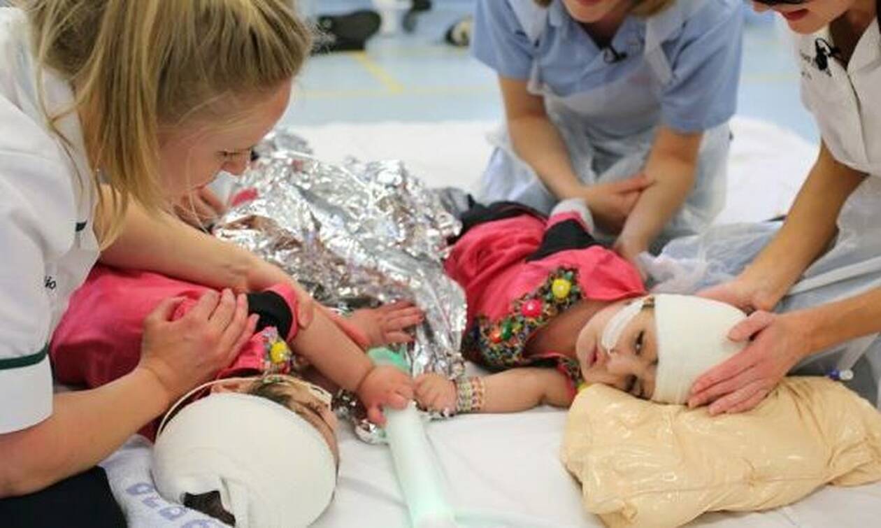 Ιατρικός μαραθώνιος έδωσε ζωή σε δύο σιαμαία κορίτσια