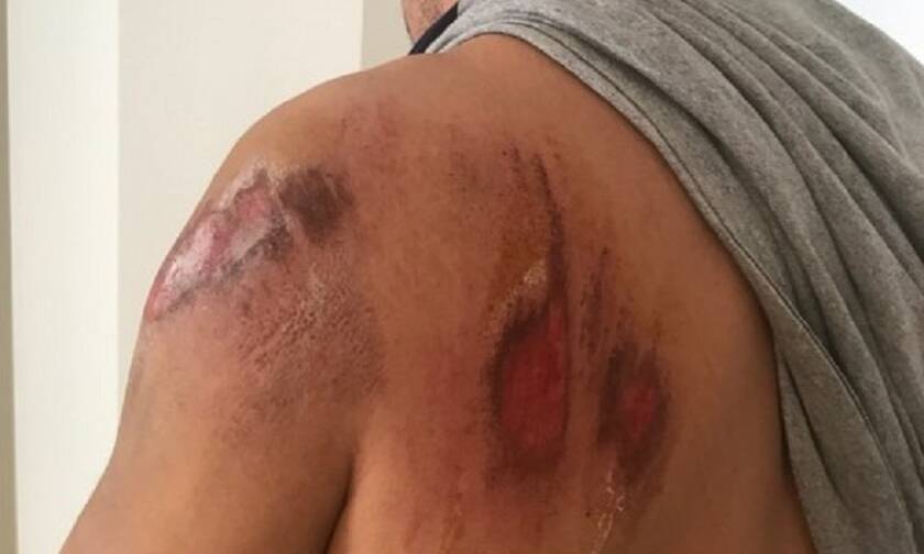 Αγρίνιο: Ποδηλάτης αστυνομικός τραυματίστηκε σοβαρά από επίθεση σκύλου