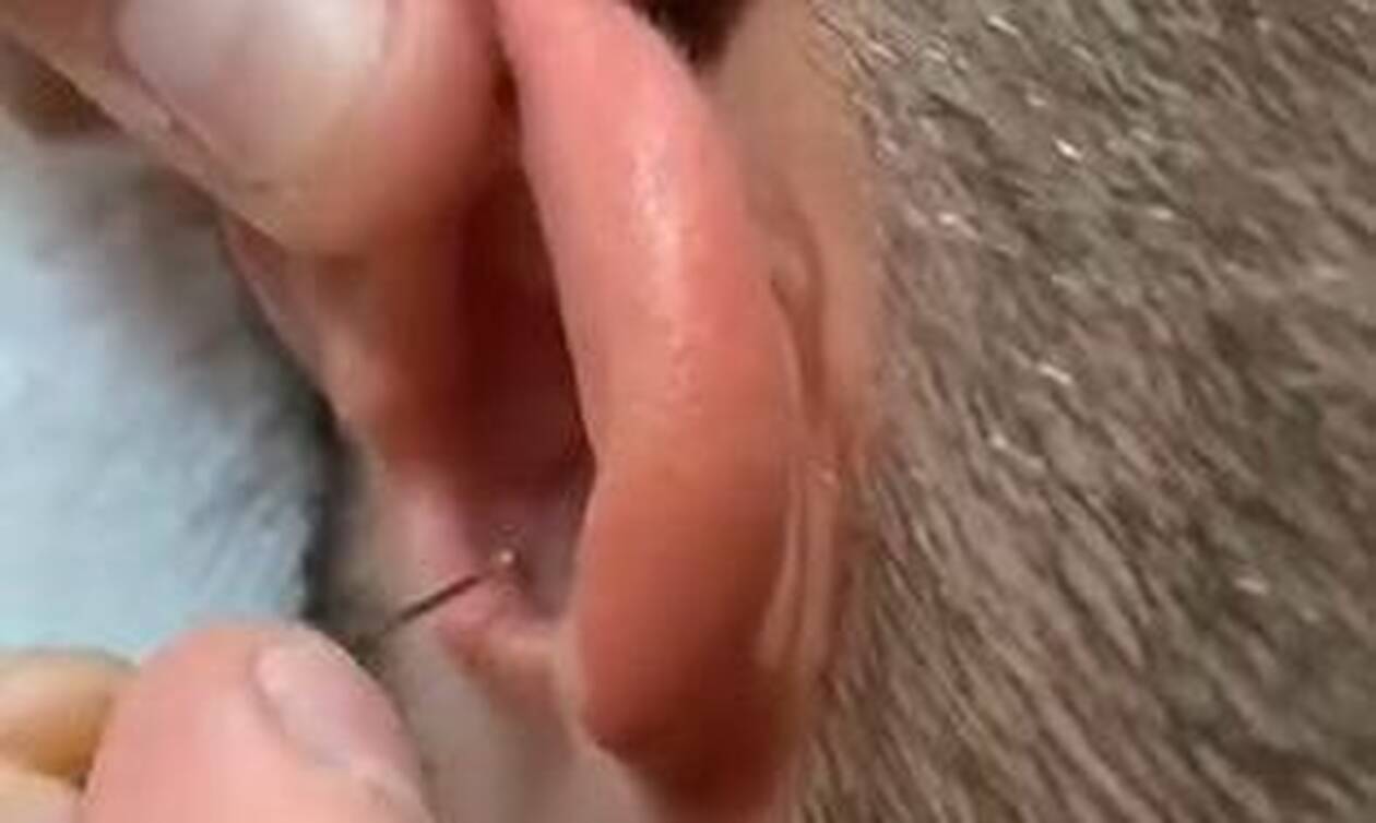 Πίστευε πως έχασε την ακοή του – Έπαθαν ΣΟΚ όταν ανακάλυψαν τι είχε στο αυτί του (pics)