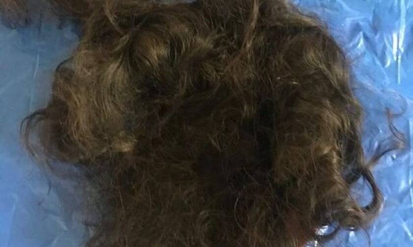 Τρομακτικές εικόνες: Πιάστηκαν τα μαλλιά της σε μηχάνημα και της ξεριζώθηκε το κρανίο
