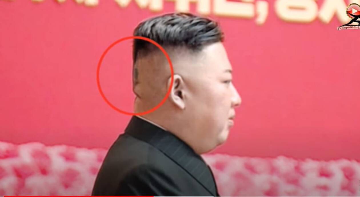 Β. Κορέα: «Μυστηριώδες» τσιρότο στο κεφάλι του Κιμ Γιονγκ Ουν πυροδοτεί νέες φήμες για την υγεία του