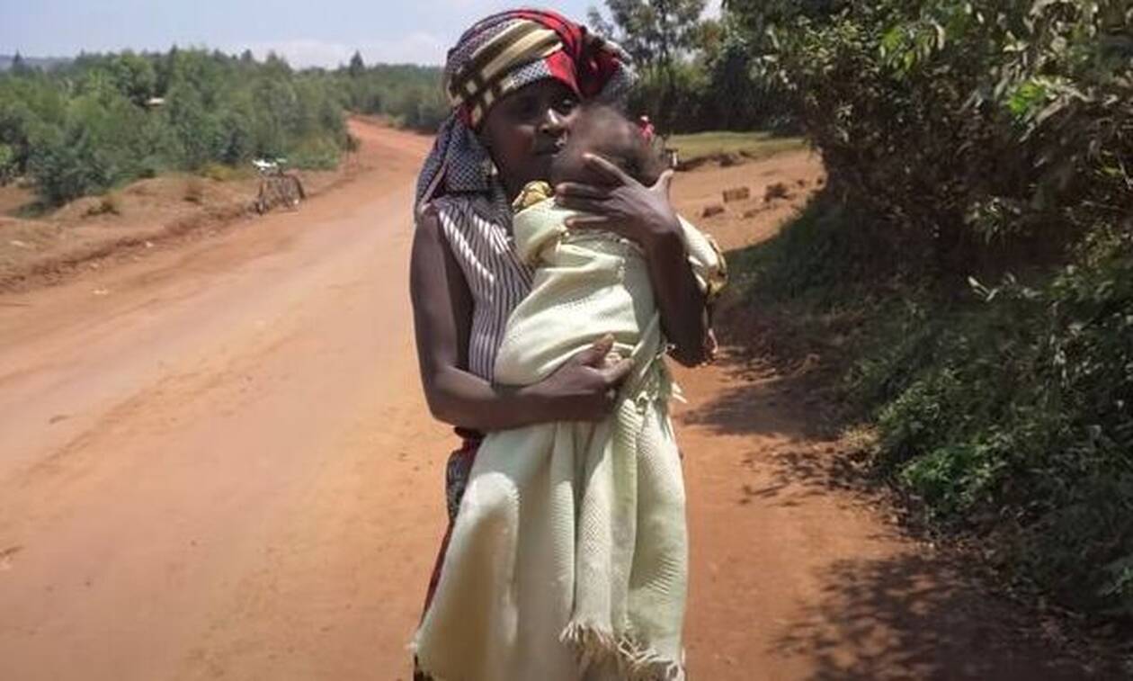 Ρουάντα: Παιδί γεννήθηκε με σπάνια παραμορφωτική ασθένεια - Το παράτησε ο πατέρας του