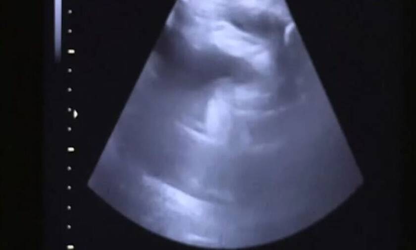 Γολγοθάς για 40χρονη: Περιφερόταν με νεκρό έμβρυο στην κοιλιά για δέκα ημέρες (video)