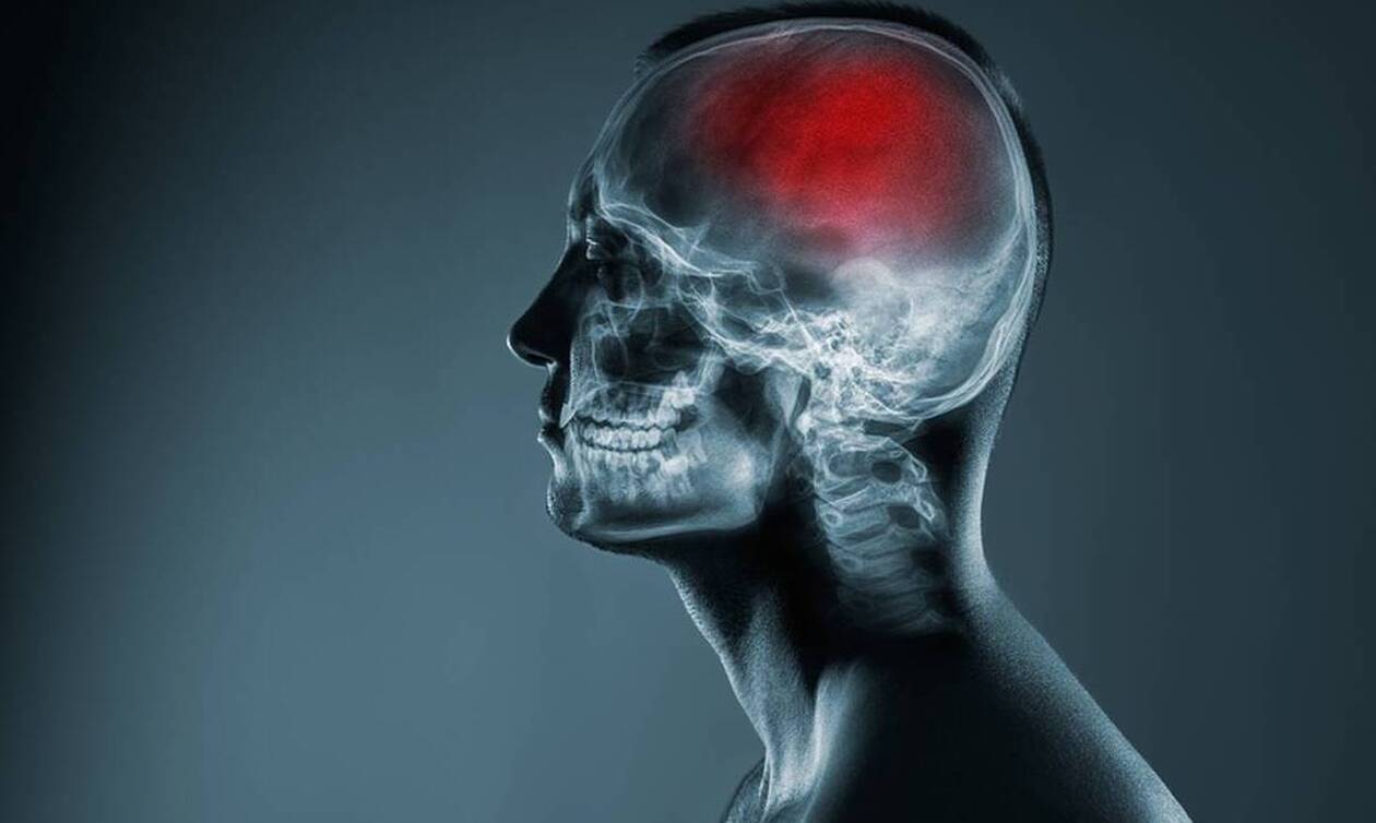 Ο κίνδυνος εγκεφαλικού είναι μεγαλύτερος τις πρώτες τρεις ημέρες μετά τη διάγνωση κορονοϊού