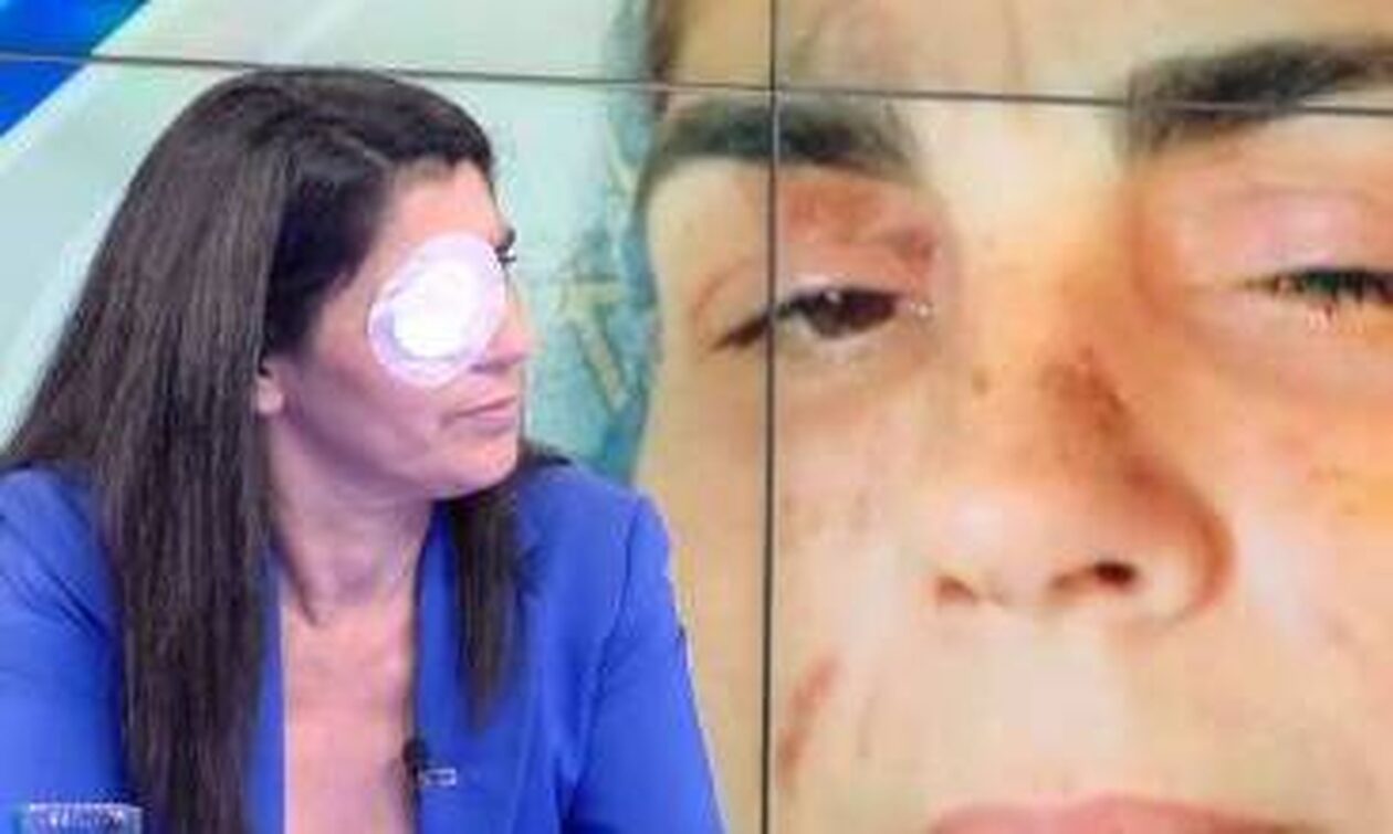 Επίθεση με οξύ στη Μεσσήνη: «Ούρλιαζα, καιγόμουν» περιγράφει η 49χρονη
