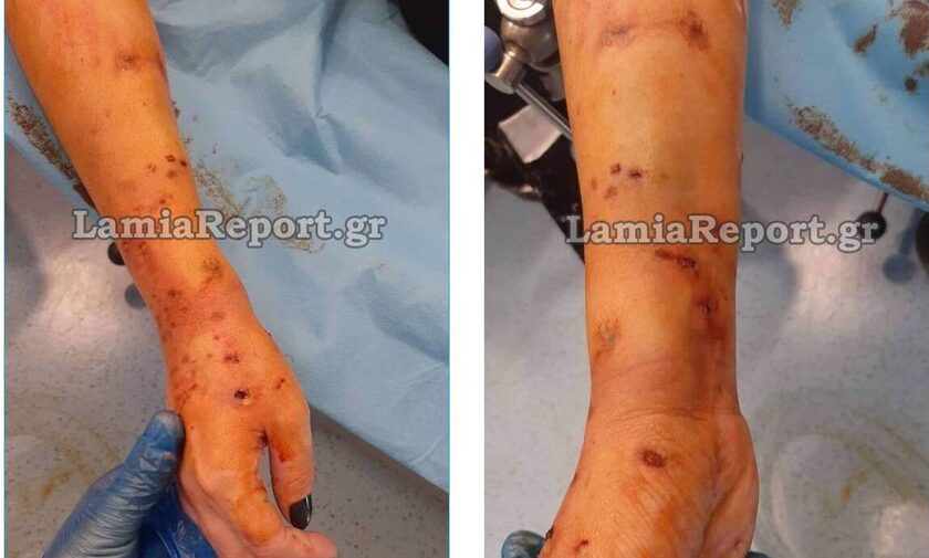 Λαμία: Ξεκίνησε να πάει στη δουλειά και βρέθηκε στο νοσοκομείο – Άγρια επίθεση σκύλου σε 35χρονη
