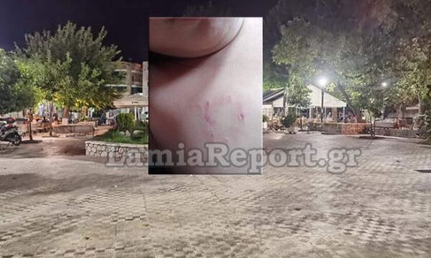 Λαμία: Σκύλος επιτέθηκε σε παιδάκι μέσα στην πλατεία