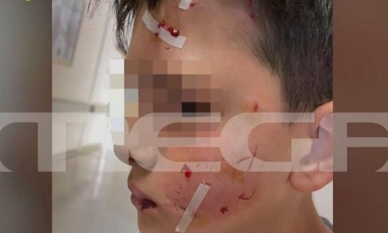 Λαγονήσι: Συγκλονίζει η μητέρα του 14χρονου που δέχθηκε επίθεση σκύλου