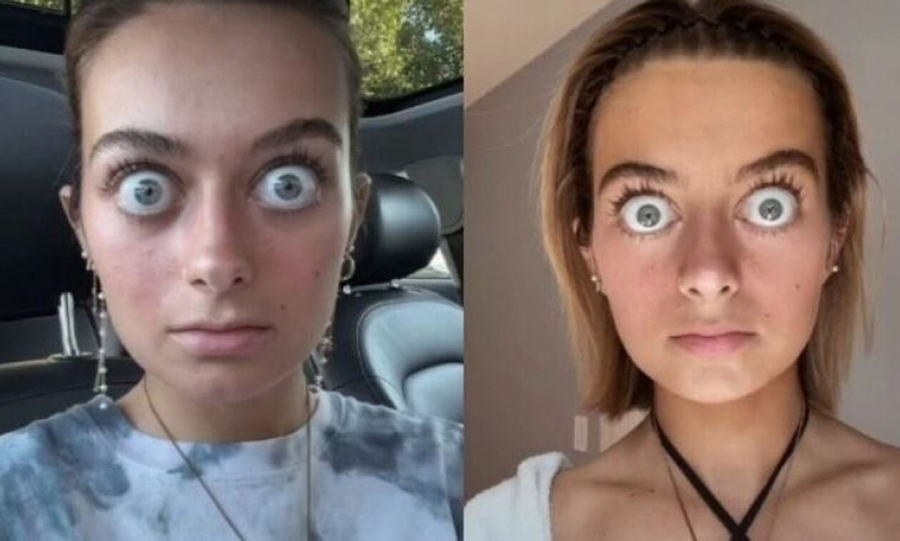 «Με συγκρίνουν με το Gollum»: Η κοπέλα με τα μεγάλα μάτια που έγινε viral