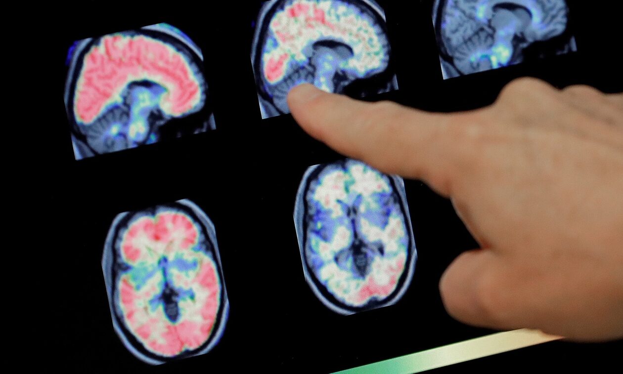 Γλοίωμα εγκεφάλου: Διάγνωση και διαχείριση ενός τύπου καρκίνου με «ύπουλα» συμπτώματα