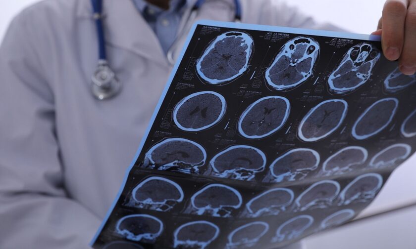 Ισχαιμικό εγκεφαλικό: Η φροντίδα & η πρόληψη δεύτερου εγκεφαλικού