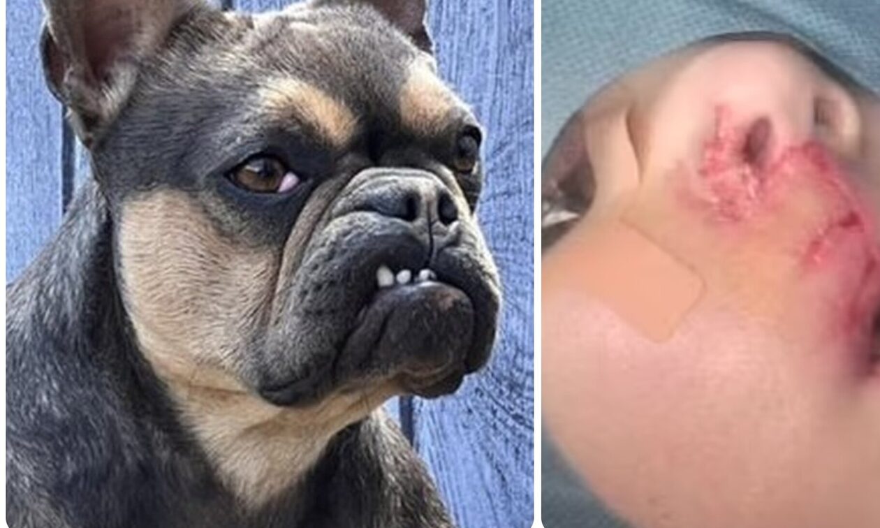 Βρετανία: Άγρια επίθεση σκύλου σε τρίχρονο αγόρι – Έχασε το 60% του άνω χείλους του  