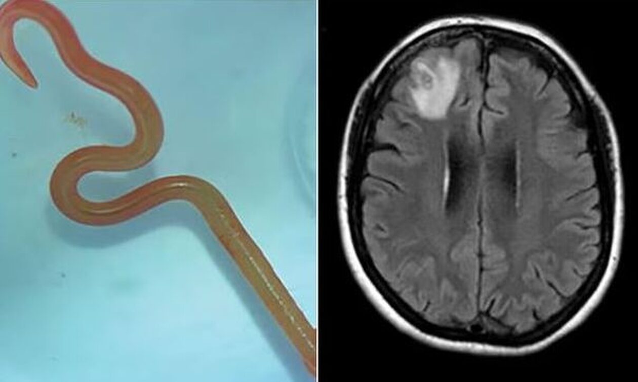 Αυστραλία: Αφαίρεσαν ζωντανό σκουλήκι 8 εκατοστών από τον εγκέφαλο ασθενούς