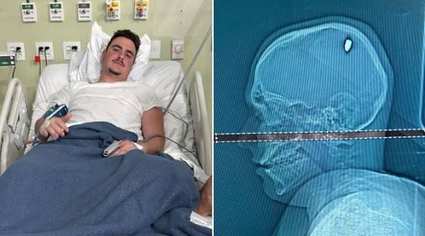 Βραζιλιάνος φοιτητής διασκέδαζε επί 4 ημέρες με μια σφαίρα σφηνωμένη στο... κεφάλι του