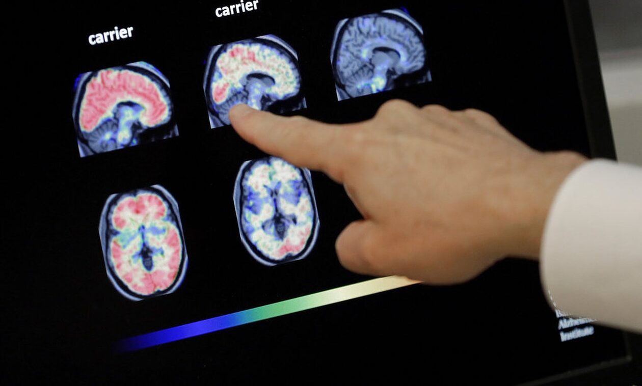Αλτσχάιμερ: Μελέτη αποκαλύπτει περιστατικά μετάδοσης σε ανθρώπους