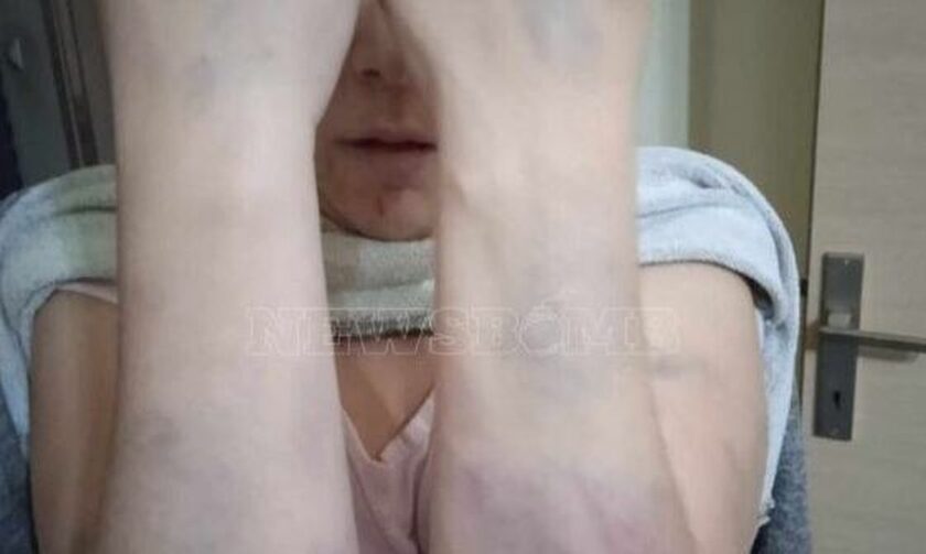 Άργος: Φωτογραφίες ντοκουμέντο από τη φρίκη στα χέρια του συζύγου της - «Μου είπε θα φτύσεις αίμα»