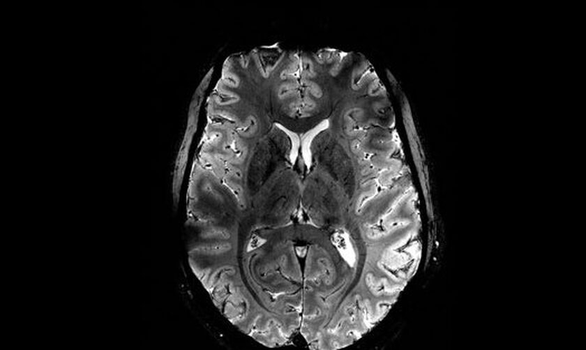 Για πρώτη φορά ζωντανός εγκέφαλος απεικονίζεται καθαρά στον ισχυρότερο μαγνητικό τομογράφο