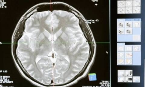 O ανθρώπινος εγκέφαλος έχει μεγαλώσει κατά 7%από το 1930 - Ο δείκτης νοημοσύνης έχει υποχωρήσει