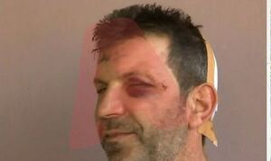Αγρίνιο: «Μου άνοιξαν το κεφάλι σε δύο σημεία», αποκαλύπτει ο μαγαζάτορας για την επίθεση από Ρομά